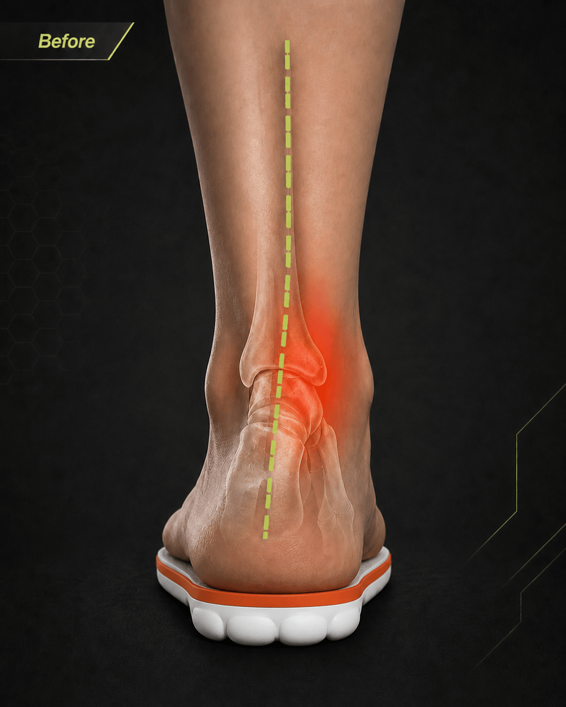 Without SOLVIX - arch collapse, heel pain